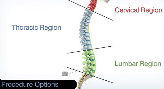 A Spinal Cord Stimulator Could be the Drug-Free Solution to Your Chronic Back  Pain : Interventional Pain and Regenerative Medicine Specialists: Pain  Management