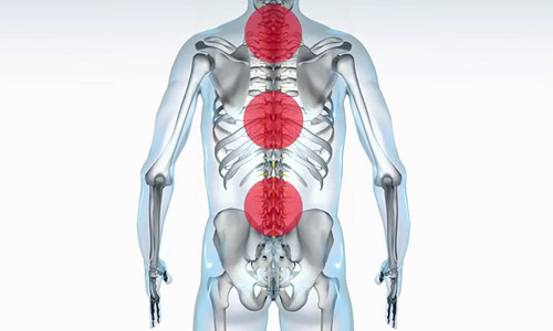 HF-10 Spinal Cord Stimulation for Pain