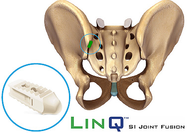 LinQ™ - SI Joint Fusion